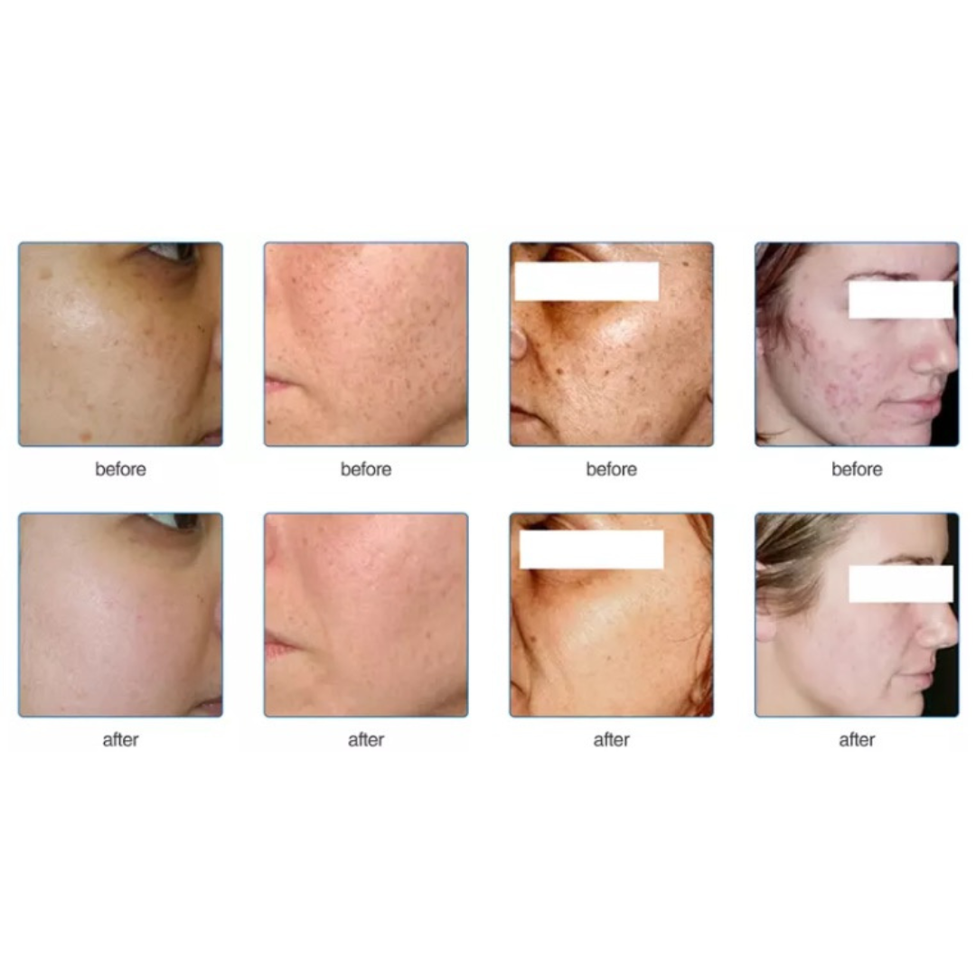 Before and after skin rejuvenating IPL treatment on Face