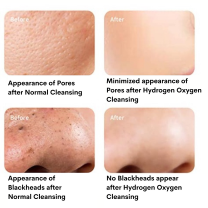 Before and after results of normal skin cleansing versus professional  hydrogen oxygen cleansing, appearance of Pores size and blackheads. 